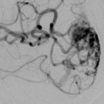 Post-Embolization 1, prior to Gamma Knife Radiotherapy