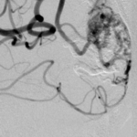 Post-Embolization 2, prior to Gamma Knife Radiotherapy