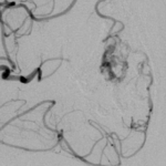 Post-Embolization 2, prior to Gamma Knife Radiotherapy