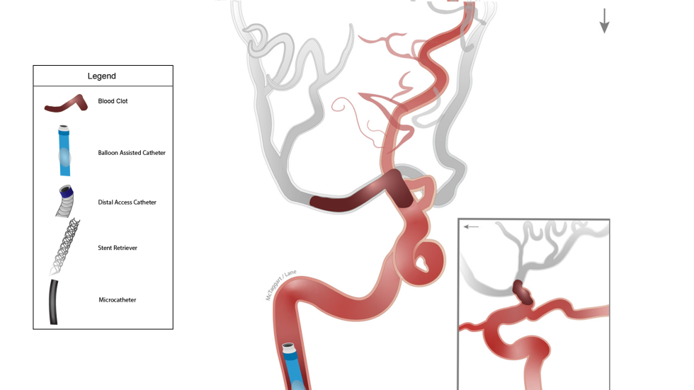 Illustration of Captive procedure with balloon-assisted catheter.