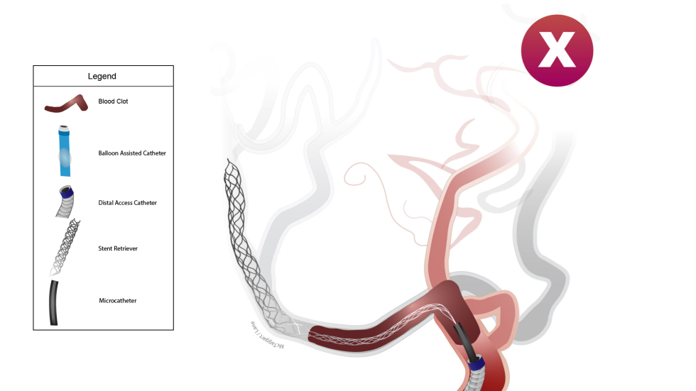 Illustration of Captive procedure with balloon-assisted catheter.