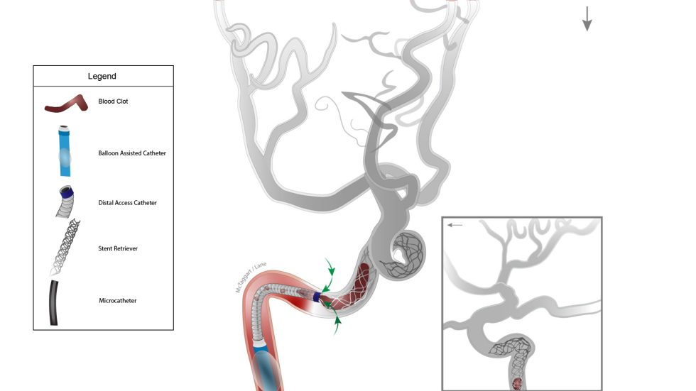 Illustration of Captive procedure with balloon-assisted catheter.