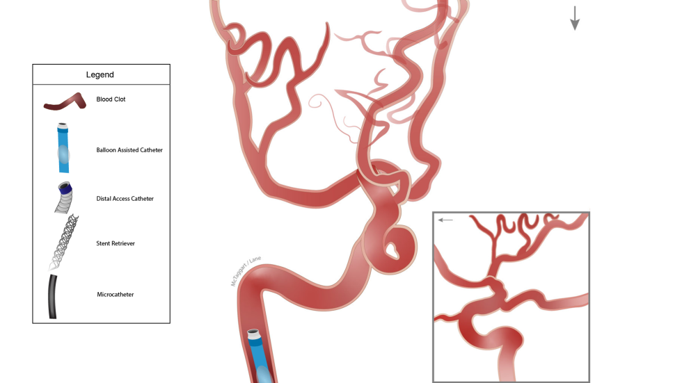 Illustration of Captive procedure with balloon-assisted catheter.