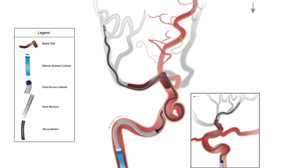 Illustration of Captive procedure with balloon assisted catheter