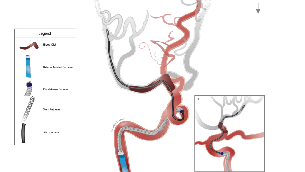 Illustration of Captive procedure with balloon-assisted catheter.