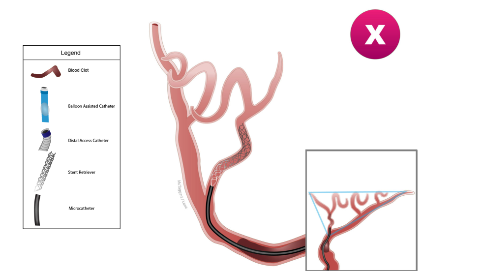 Illustration of Captive procedure with balloon-assisted catheter.