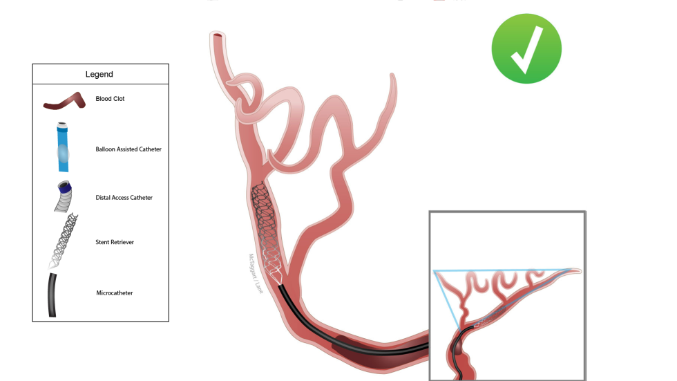 Illustration of Captive procedure with balloon-assisted catheter.