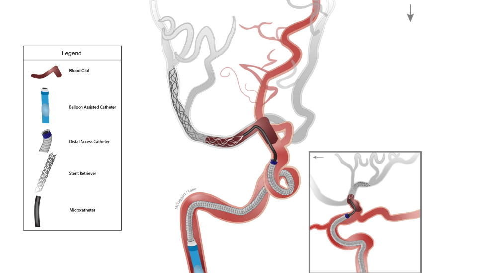 Illustration of Captive procedure with balloon-assisted catheter.