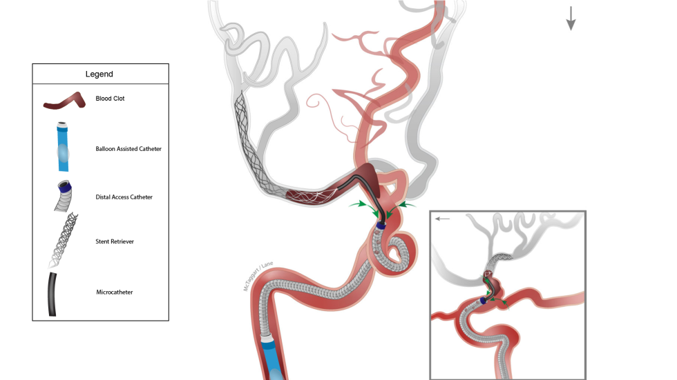 Illustration of Captive procedure with balloon-assisted catheter.