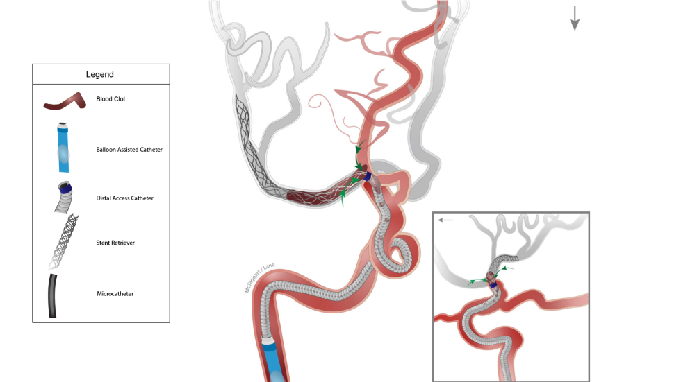 Illustration of Captive procedure with balloon-assisted catheter.