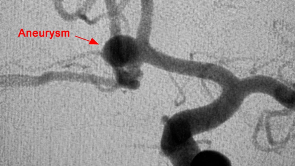 Surgical Clipping