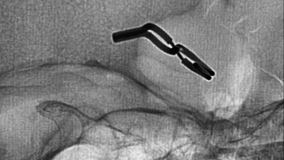 Surgical Clip