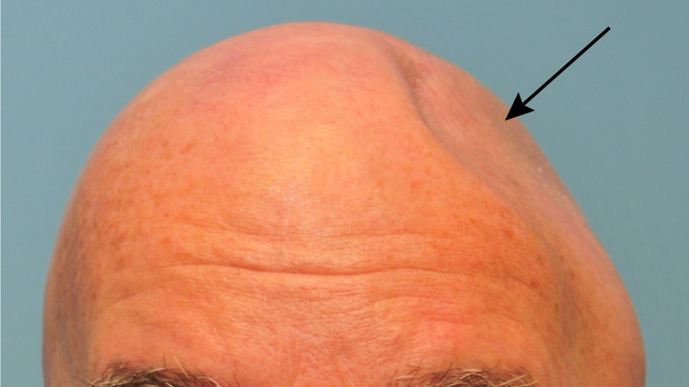 cranioplasty