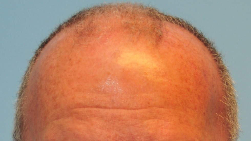 cranioplasty