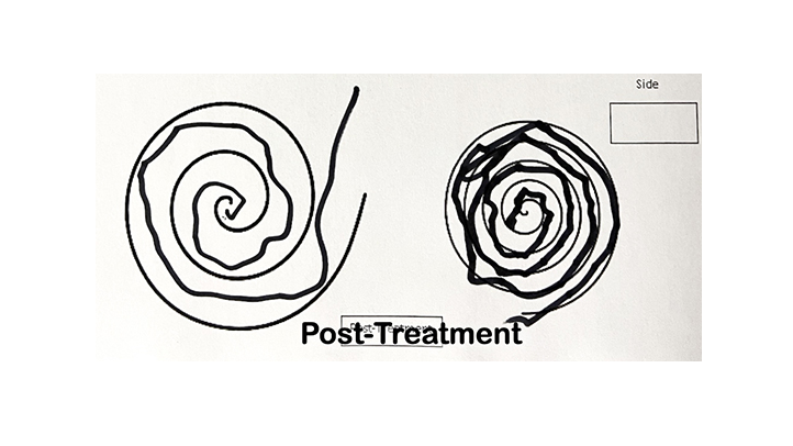 After Focused Ultrasound treatment