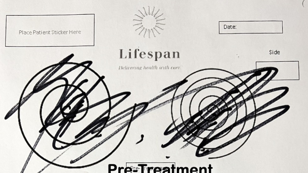 Before functional ultrasound treatment
