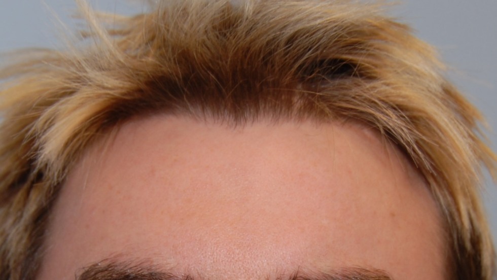 cranioplasty