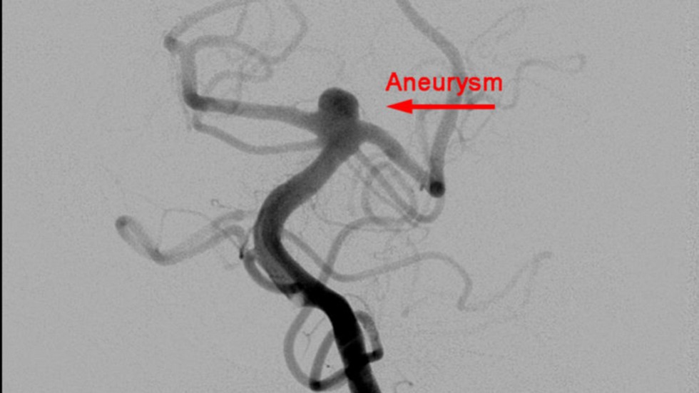 Y-Shaped Stent: Before
