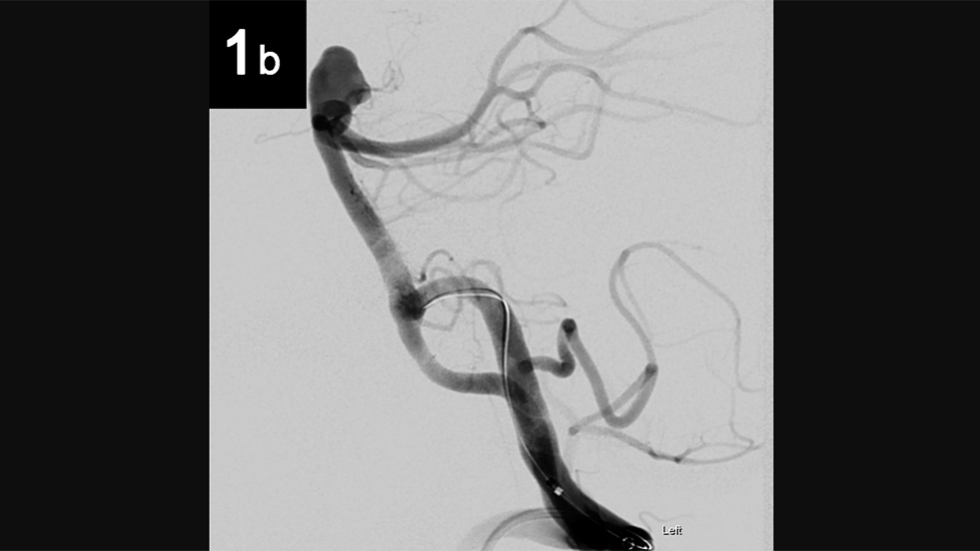 Intrasaccular: 1b