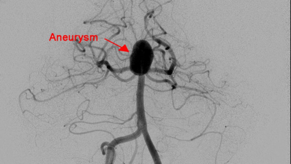 L-Shaped Stent: Before