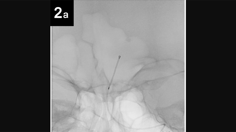 Intrasaccular: 2a