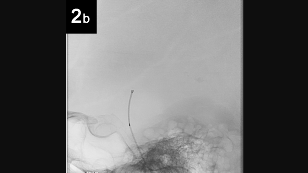 Intrasaccular: 2b