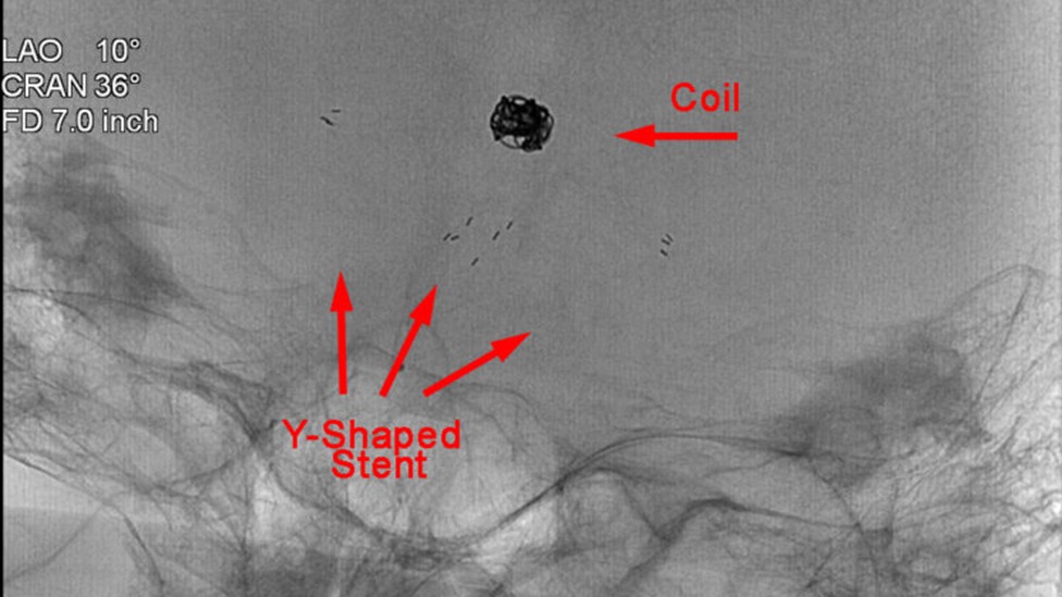 Y-shaped stent