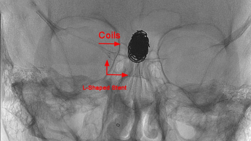 L-Shaped Stent