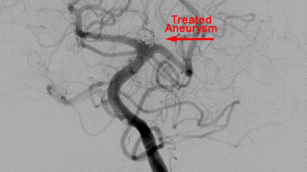 Y-Shaped Stent: After