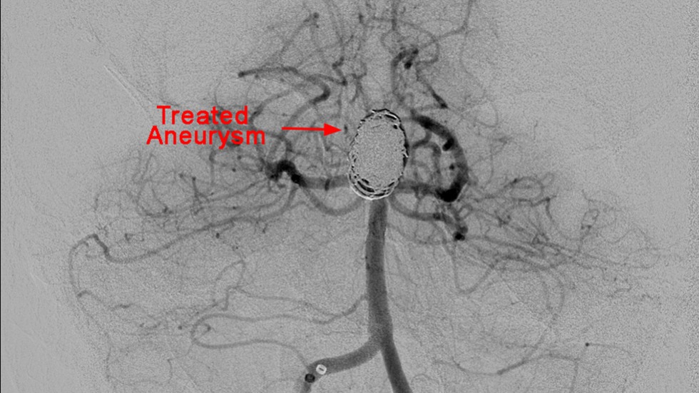 L-Shaped Stent: After
