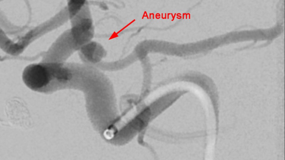 Primary Coil Embolization, Technique: Aneurysm