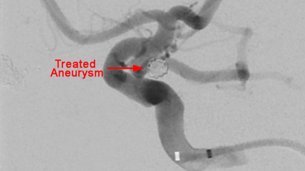 Technique: Treated Aneurysm