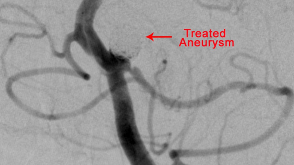 Balloon-Assisted Coiling: Treated Aneurysm