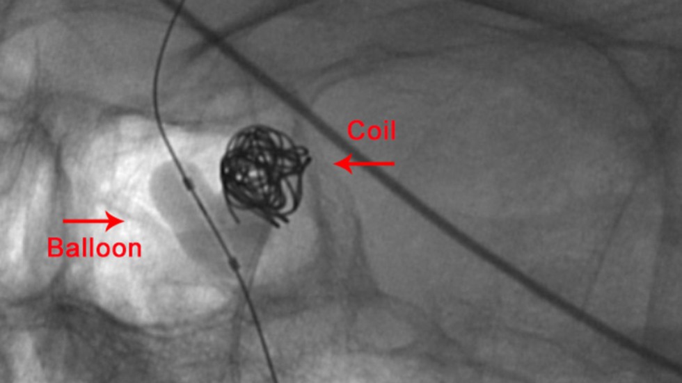 Balloon-Assisted Coiling